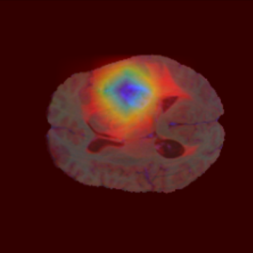 Brain Tumor Segmentation – Hybrid CNN-Transformer